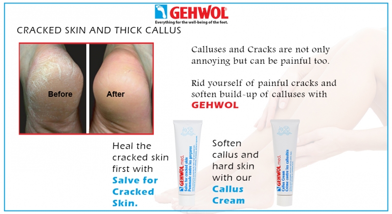 Gehwol cracked deals heel cream